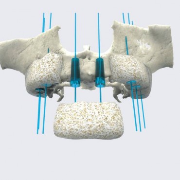 Enxerto Ósseo em Novo Hamburgo - RS