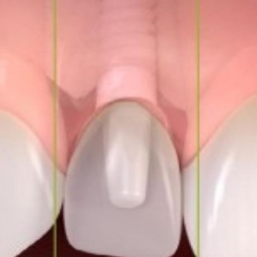 Cirurgia Guiada em Novo Hamburgo - RS