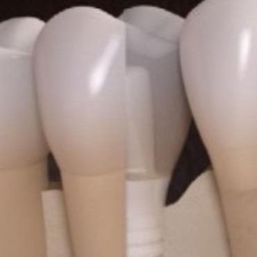 Implantes Cerâmicos em Novo Hamburgo - RS