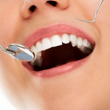 Recobrimento de Exposição Radicular em Novo Hamburgo - RS