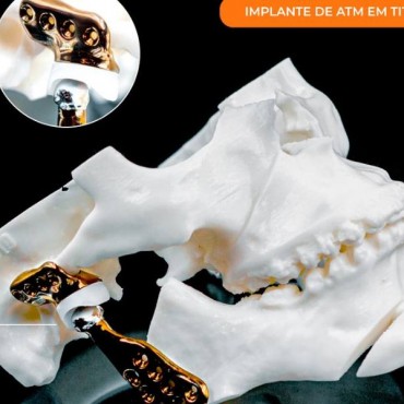 Disfunção Temporomandibular em Novo Hamburgo - RS