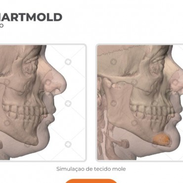 Mentoplastia em Novo Hamburgo - RS