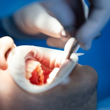 Gengivoplastia em Novo Hamburgo - RS