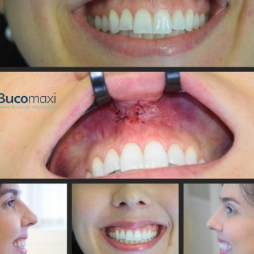 Redução do Sorriso Gengival em Novo Hamburgo - RS