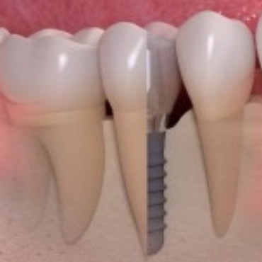 Implantes Dentários em Novo Hamburgo - RS