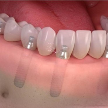 Carga Precoce em Novo Hamburgo - RS