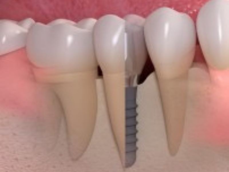 Implantes Dentários